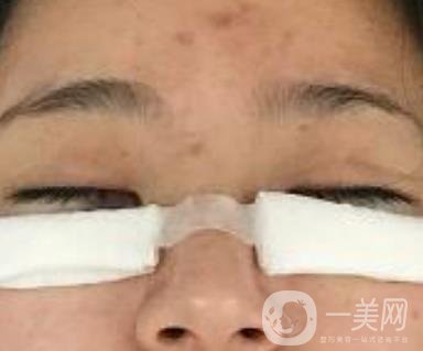 第一醫(yī)院去眼袋