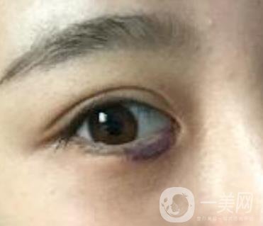 第一醫(yī)院去眼袋