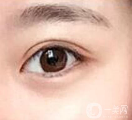 第一醫(yī)院去眼袋