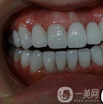 杭州格萊美醫(yī)院整牙