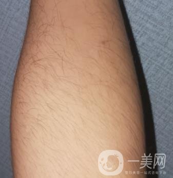 哈醫(yī)大四院整形美容科價(jià)格表鉅惠來(lái)襲，附冰點(diǎn)脫毛案例