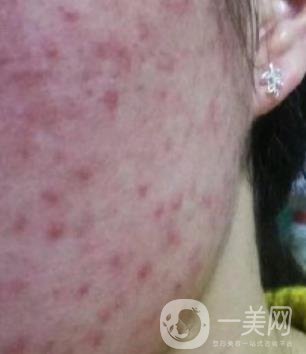 成都軍區(qū)總醫(yī)院整形美容科價格表及祛痘印真人日記