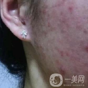 成都軍區(qū)總醫(yī)院整形美容科價格表及祛痘印真人日記