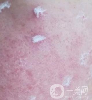 成都軍區(qū)總醫(yī)院整形美容科價格表及祛痘印真人日記