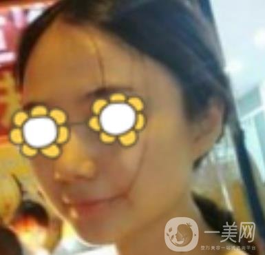 阜陽市人民醫(yī)院整形美容科價格表2020版，附*案例