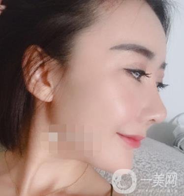 哈爾濱醫(yī)大二院整形美容科價格表上線，附*案例