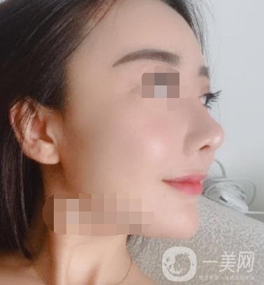 哈爾濱醫(yī)大二院整形美容科價格表上線，附*案例