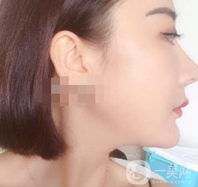 哈爾濱醫(yī)大二院整形美容科價格表上線，附*案例