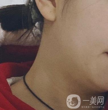 河南省人民醫(yī)院整形美容科價(jià)格表公布，附除腋臭案例