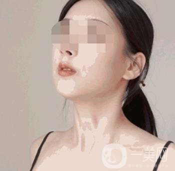 河南省人民醫(yī)院整形美容科價(jià)格表公布，附除腋臭案例