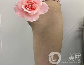 邢臺(tái)人民醫(yī)院整形美容科價(jià)格表，附大腿吸脂案例