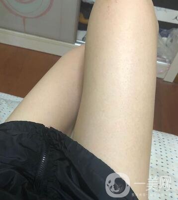 邢臺(tái)人民醫(yī)院整形美容科價(jià)格表，附大腿吸脂案例