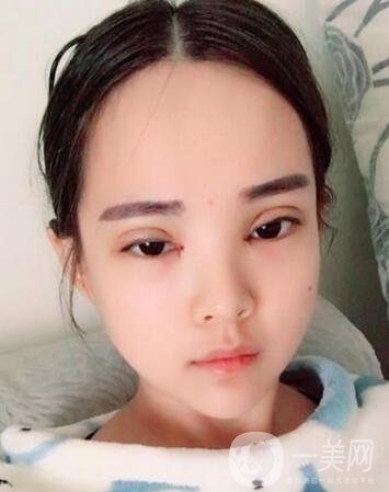 湖南第一醫(yī)院整形科價(jià)格表，附雙眼皮案例