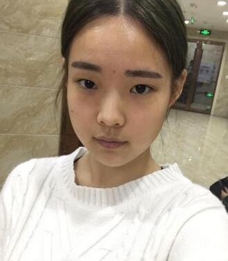 湖南第一醫(yī)院整形科價(jià)格表，附雙眼皮案例