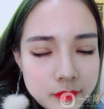湖南第一醫(yī)院整形科價(jià)格表，附雙眼皮案例