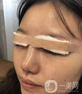 青島青醫(yī)附院整形價格表，還有雙眼皮實例