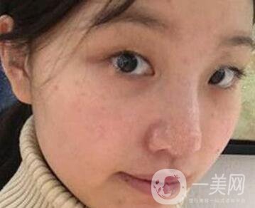 青島青醫(yī)附院整形價格表，還有雙眼皮實例