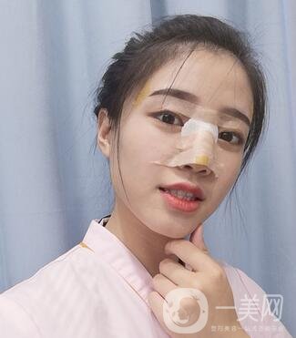 哈爾濱醫(yī)大二院美容科隆鼻*果咋樣?附價格表一覽