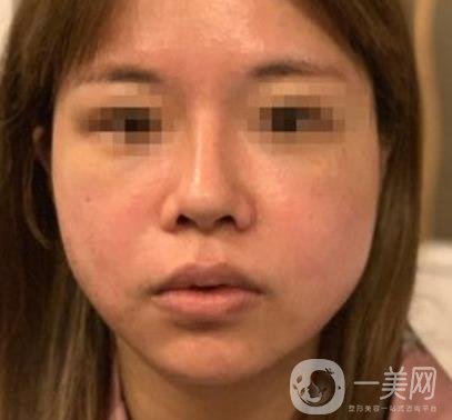 常州第一人民醫(yī)院*案例*果及整形價(jià)格表分享