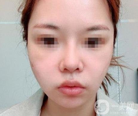 常州第一人民醫(yī)院*案例*果及整形價(jià)格表分享