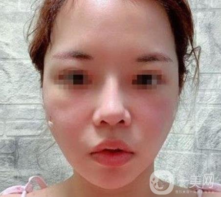 常州第一人民醫(yī)院*案例*果及整形價(jià)格表分享