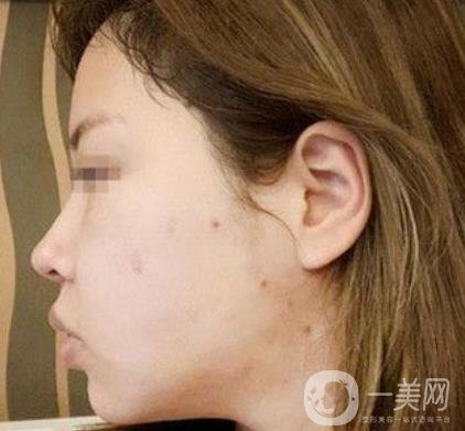 常州第一人民醫(yī)院*案例*果及整形價(jià)格表分享