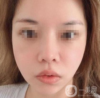 常州第一人民醫(yī)院*案例*果及整形價(jià)格表分享