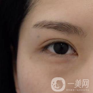 廣州人民醫(yī)院整形價(jià)格表，附去眼袋案例