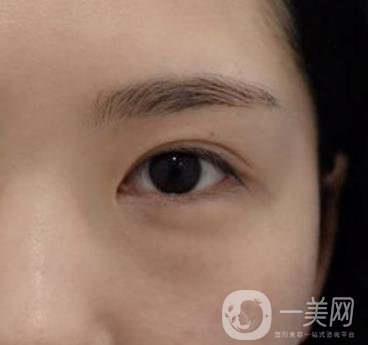 廣州人民醫(yī)院整形價(jià)格表，附去眼袋案例