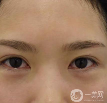 廣州人民醫(yī)院整形價(jià)格表，附去眼袋案例