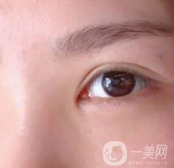 廣州人民醫(yī)院整形價(jià)格表，附去眼袋案例