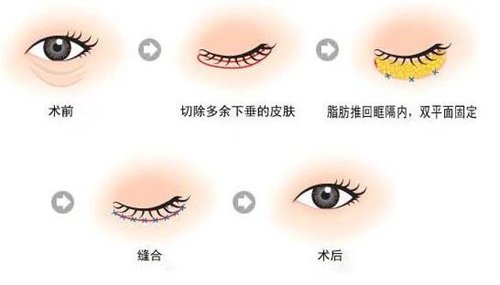 天津公安醫(yī)院整形價格表2020年，內(nèi)附做眼袋*圖