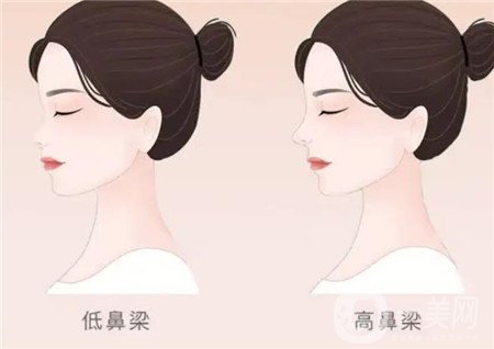 韓式耳軟骨隆鼻術(shù)*果自然嗎?好不好