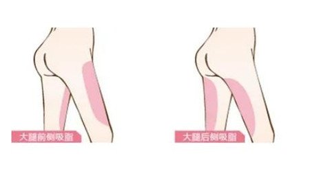 廣東,腰部吸脂,多少錢