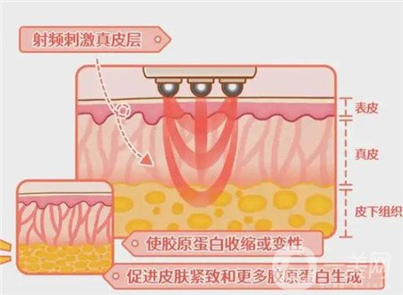 熱瑪吉電波拉皮*果怎么樣？維持多久？