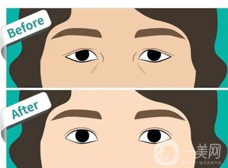 埋線雙眼皮修復(fù),埋線雙眼皮修復(fù)價格