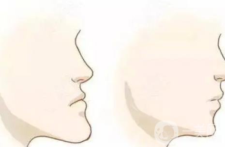 凸嘴手術(shù)多久恢復(fù)