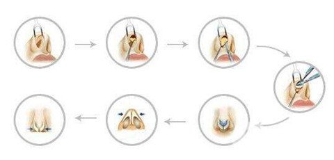 徐州二院整形美容科價(jià)格表，附隆鼻整形案例