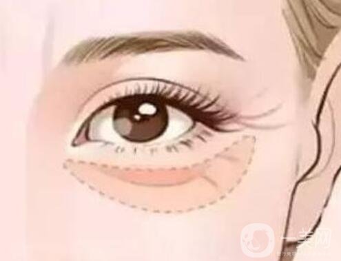 疤痕體質(zhì)去眼袋方法 疤痕體質(zhì)怎么去眼袋？