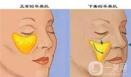 自體脂肪填充蘋果肌幾天可化妝?