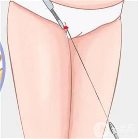 等離子光纖溶脂有危害嗎 有什么危害呢？