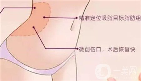 全身吸脂手術(shù)價格？馮斌做全身吸脂大概多少錢？