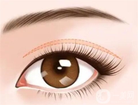 寧波市第一醫(yī)院整形美容科割雙眼皮怎么樣？價格表及案例詳情