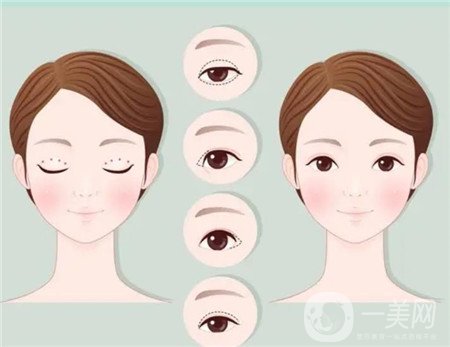 杭州格萊美醫(yī)院做雙眼皮咋樣?案例價(jià)格表公開(kāi)