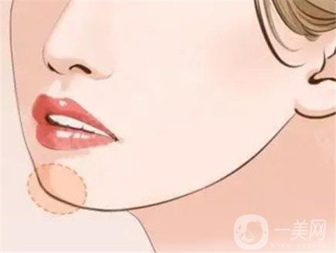 下巴做假體好還是打玻尿酸好