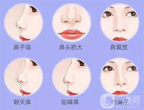 湖南省人民醫(yī)院整形美容科隆鼻*果如何？看價(jià)格表及案例實(shí)述