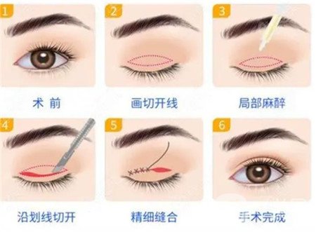 益陽市中心醫(yī)院整形美容科價(jià)格表完整版及雙眼皮修復(fù)案例瀏覽