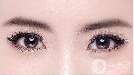 開(kāi)眼角,上海開(kāi)眼角價(jià)錢(qián),開(kāi)眼角注意事項(xiàng)