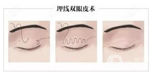 開眼角整形之后會有后遺癥嗎