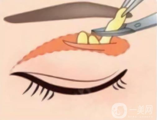 空軍總醫(yī)院做眼袋手術(shù)多少錢？掛什么科？附醫(yī)美價格表